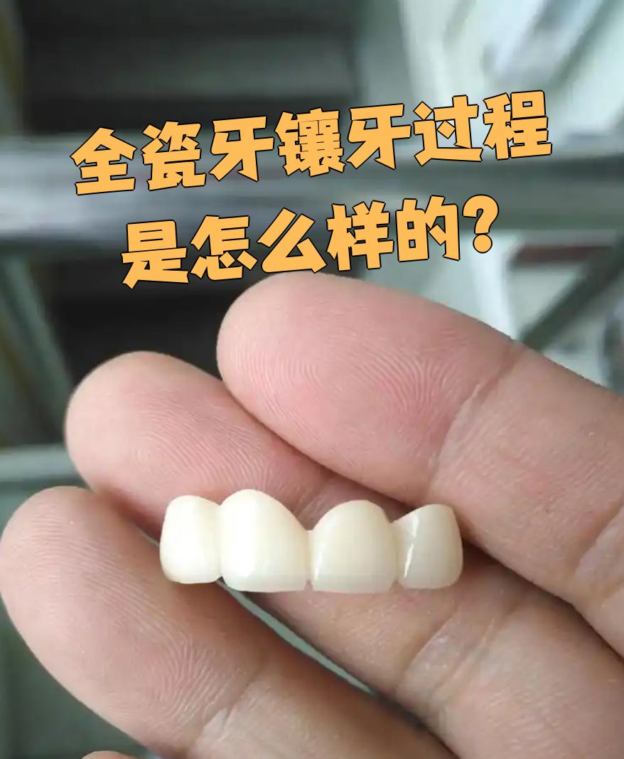 全瓷牙是烤瓷牙的一种,镶牙过程需要分好几步,主要是磨牙,制模和