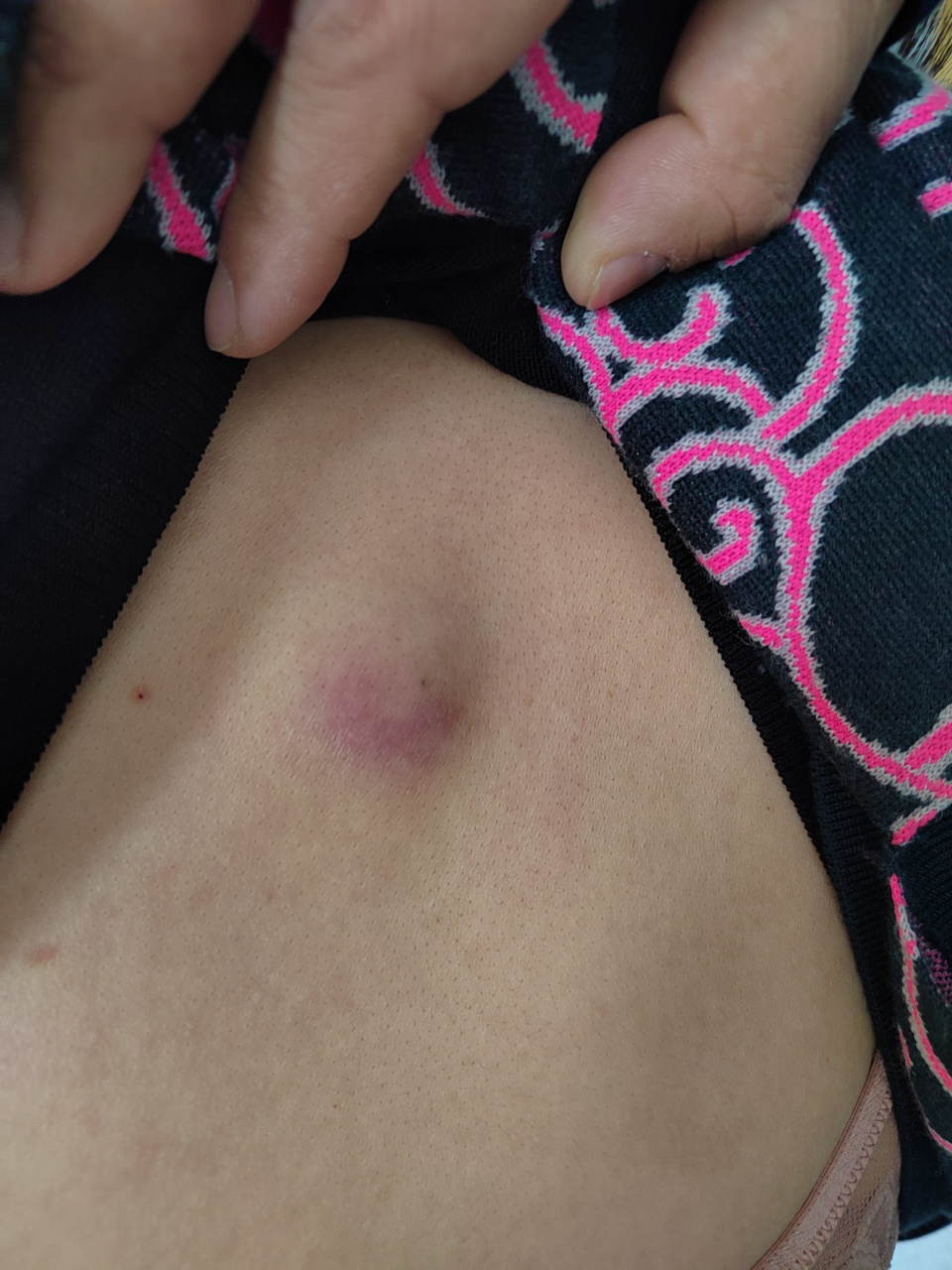 背部皮脂腺囊肿感染化脓.#皮肤感染