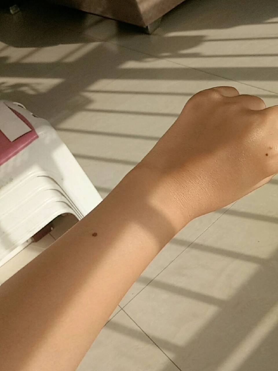 左右手为什么会长痣?