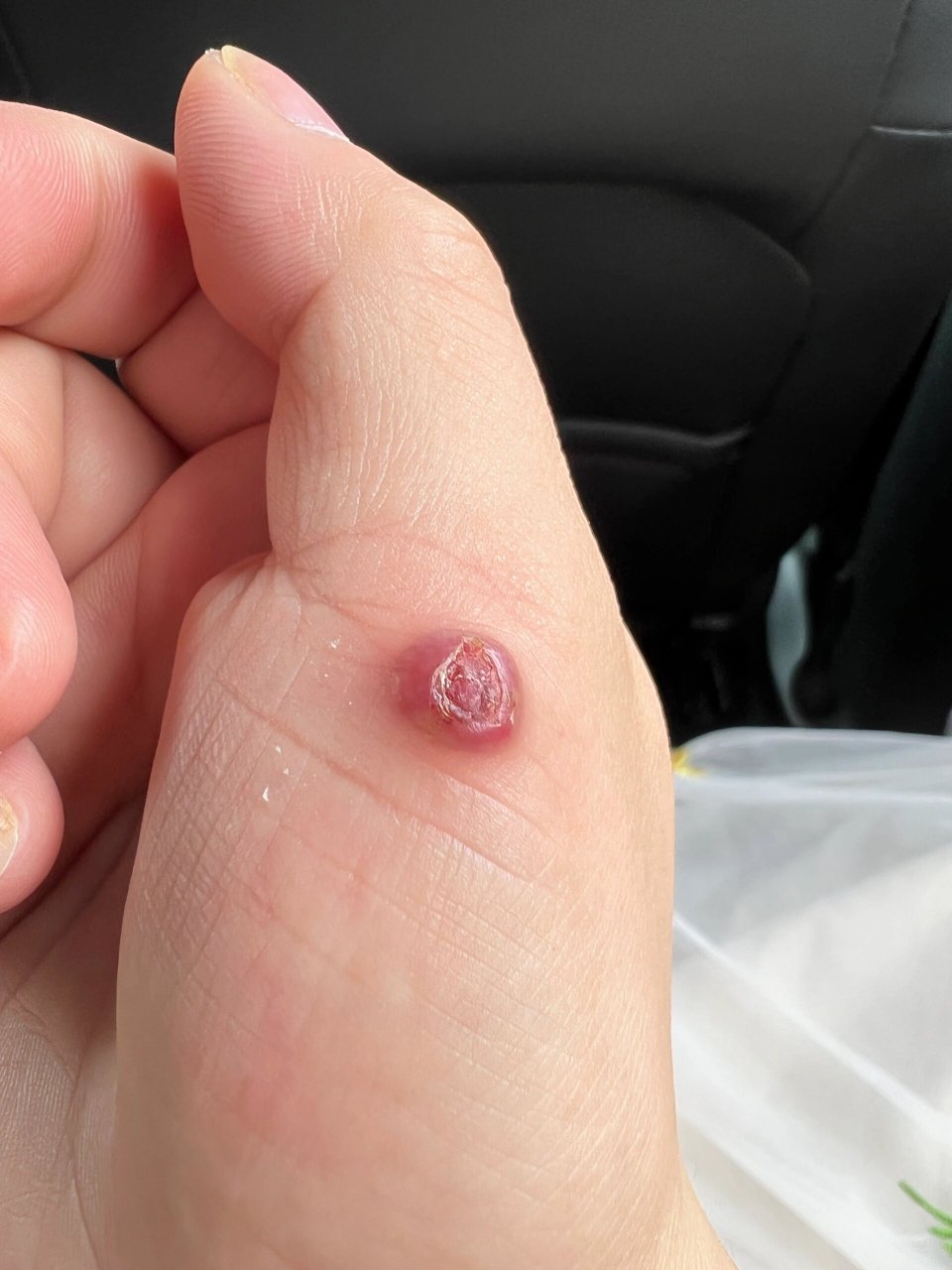 孕晚期34周4天,血管瘤(化脓性肉芽肿) 希望姐妹们不要长这么个东西