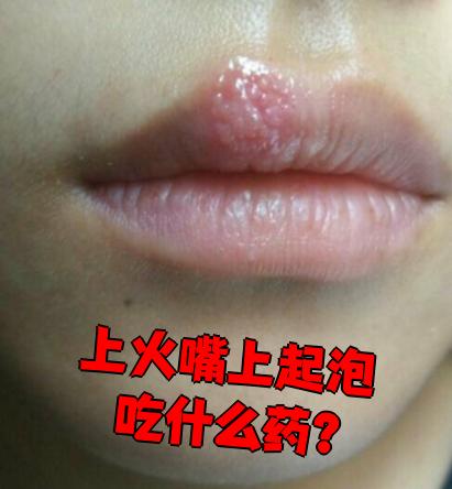 嘴上起泡可能是单纯疱疹或唇炎,最好先去医院确诊