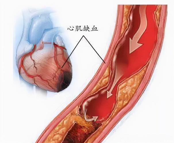 动脉粥样硬化纤维帽图片