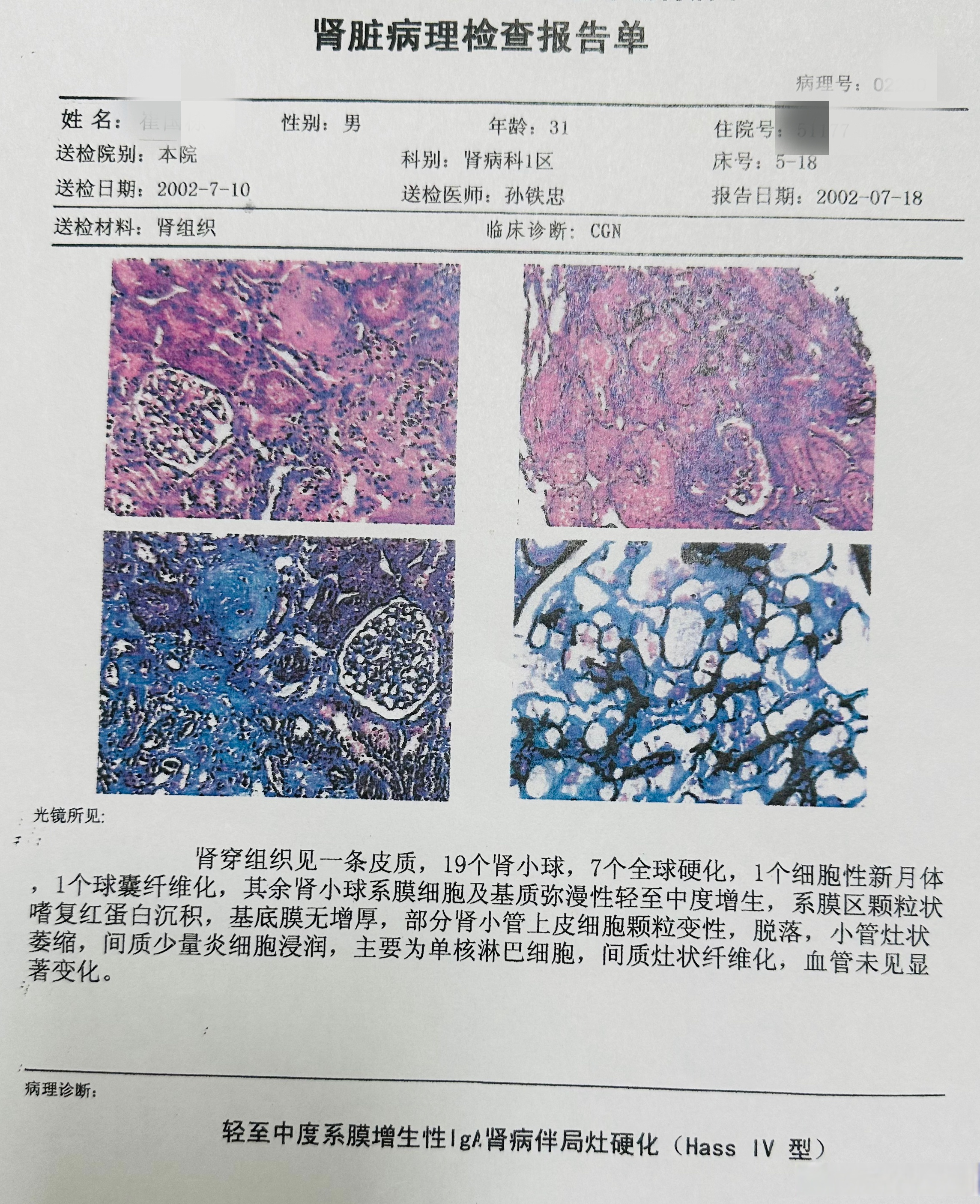iga肾病是我国常见的肾小球肾炎,病情比较重,容易发生肾衰