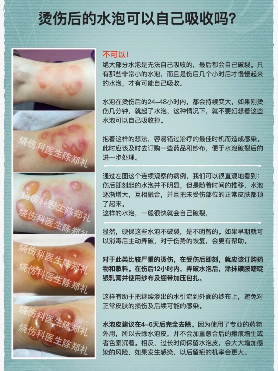 烫伤后的水泡可以自己吸收吗? 烫伤后的水泡可以自己吸收吗?