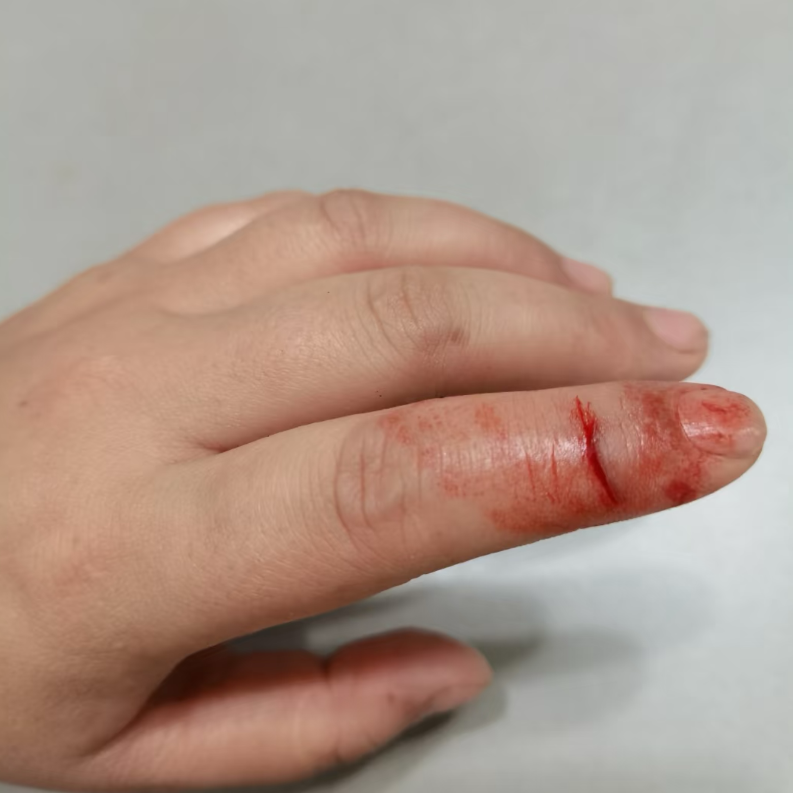 手指割破后没缝针的愈合时间要看伤口情况和是否感染