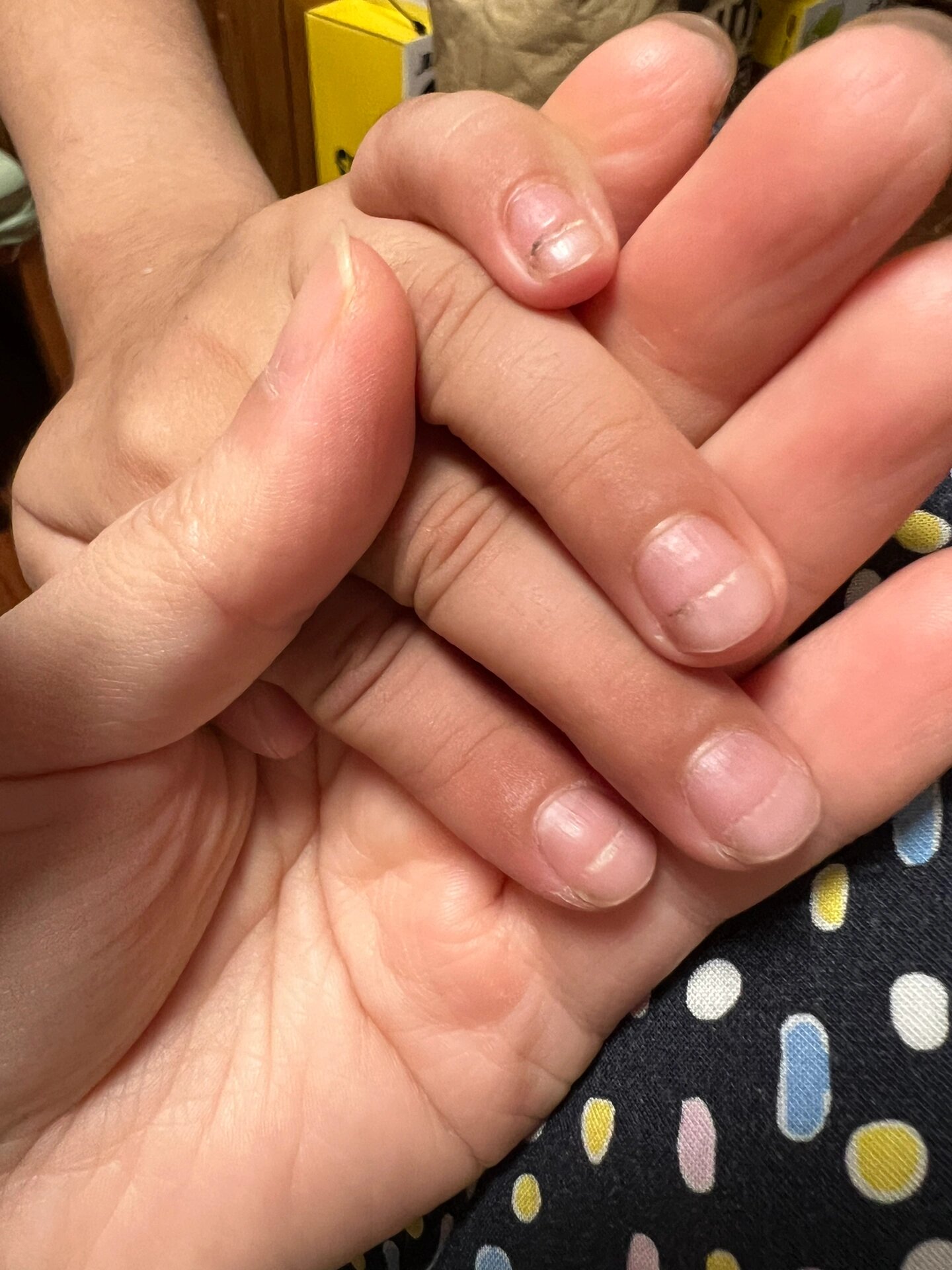 2年级小学生指甲中间有横纹凹槽怎么回事 请教2年级小学生指甲中间有