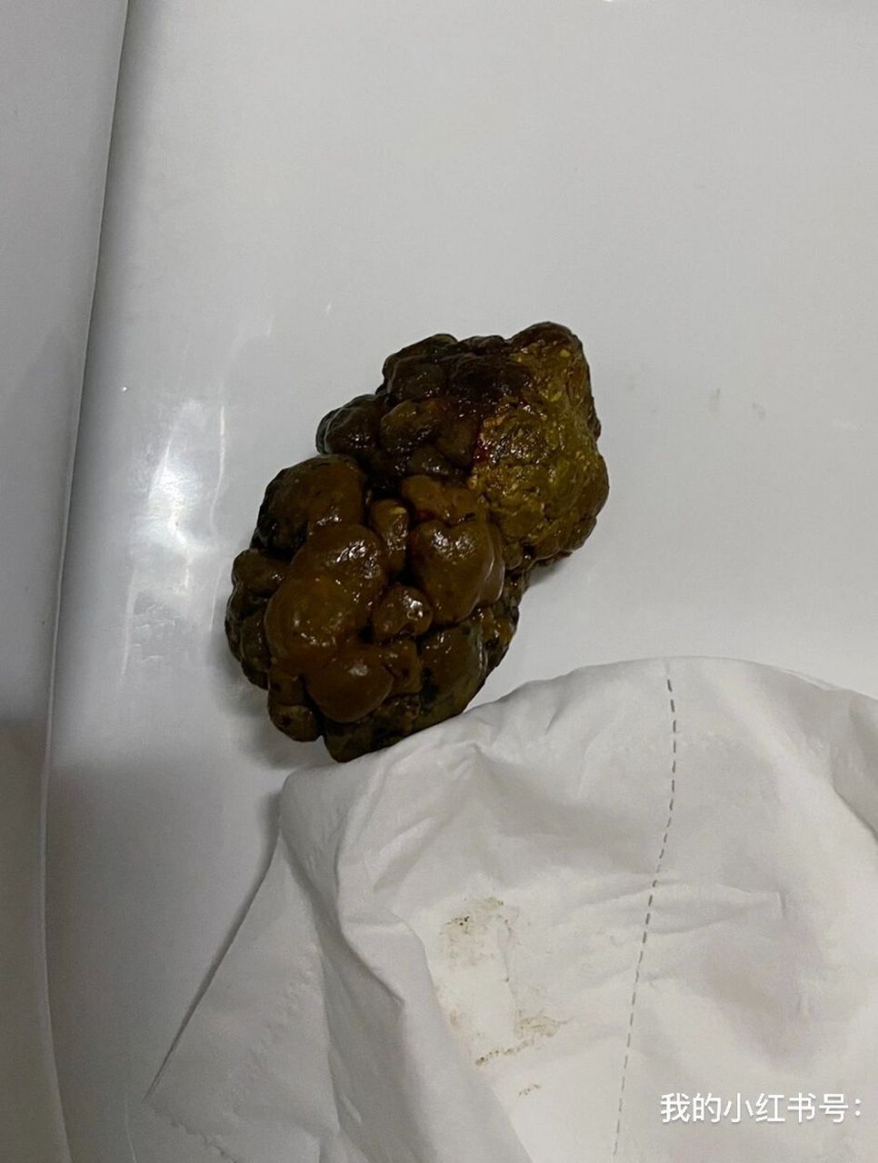 宝贝便秘三年了 (图3是便便照片,介意慎点)不好意思