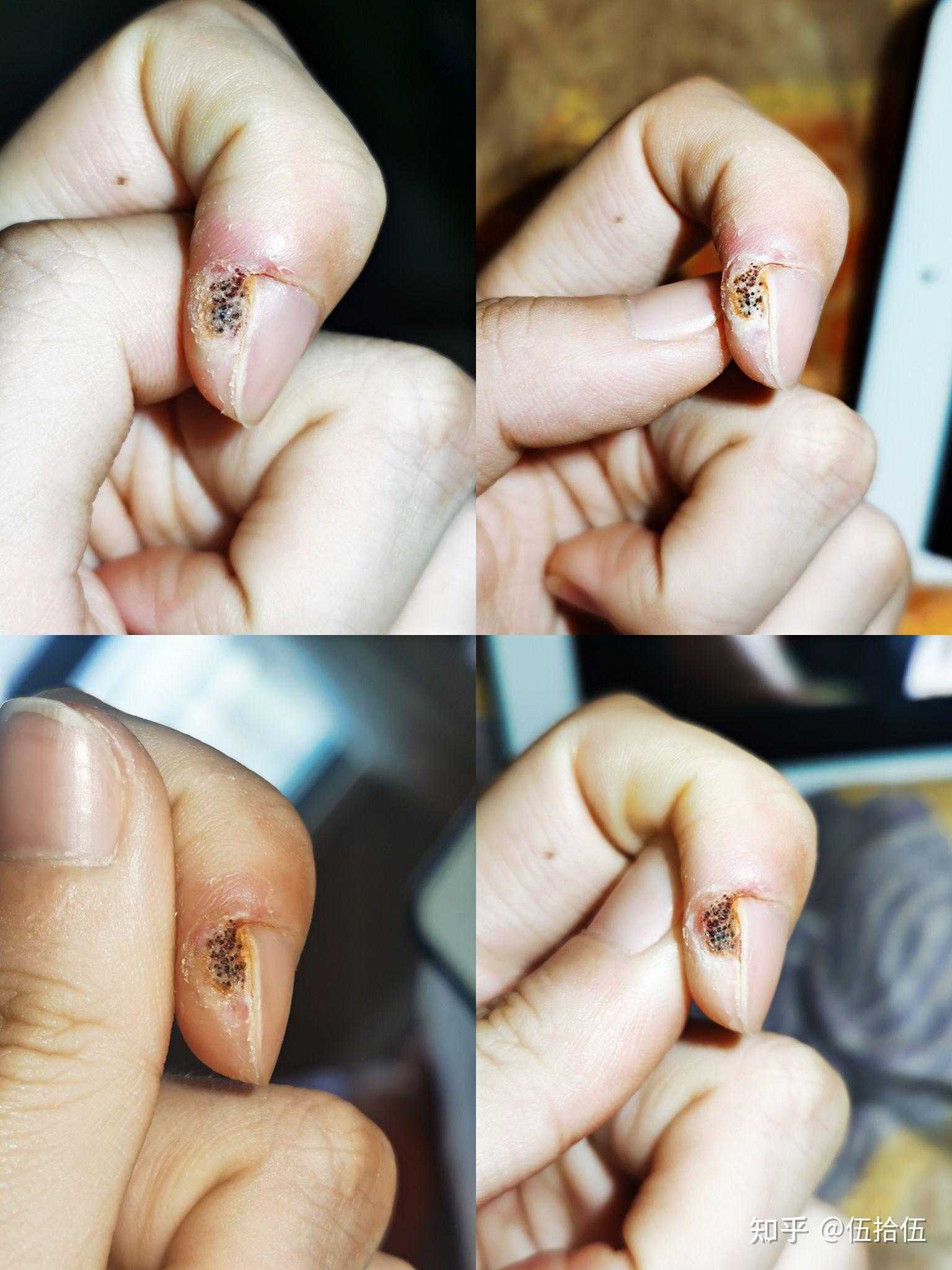 跖疣的自愈性大吗