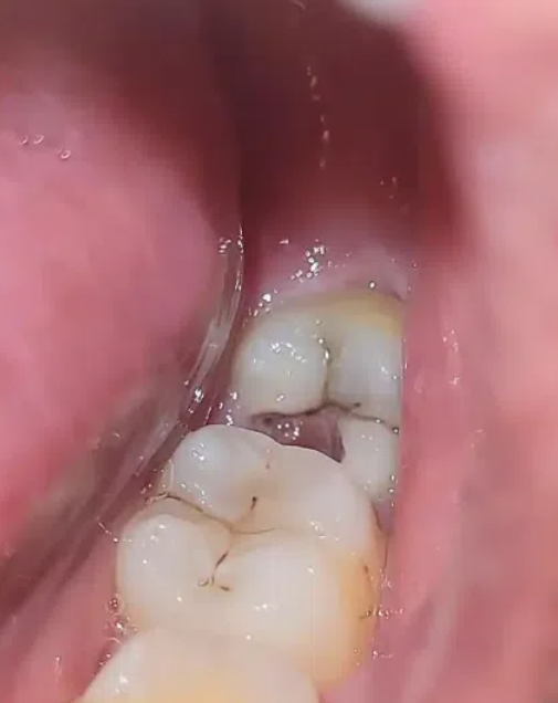 如果智齿被牙龈完全或部分包住,可能会引起发炎或感染,需要根据具体