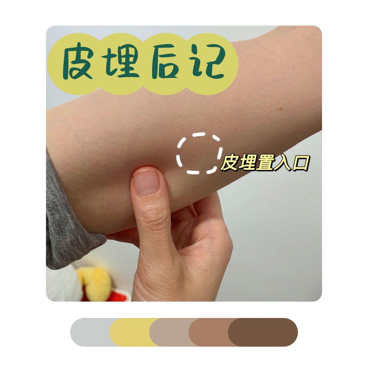 皮埋一年四个月后的后记 皮下埋植避孕针,简称"皮埋",早就在上个世纪