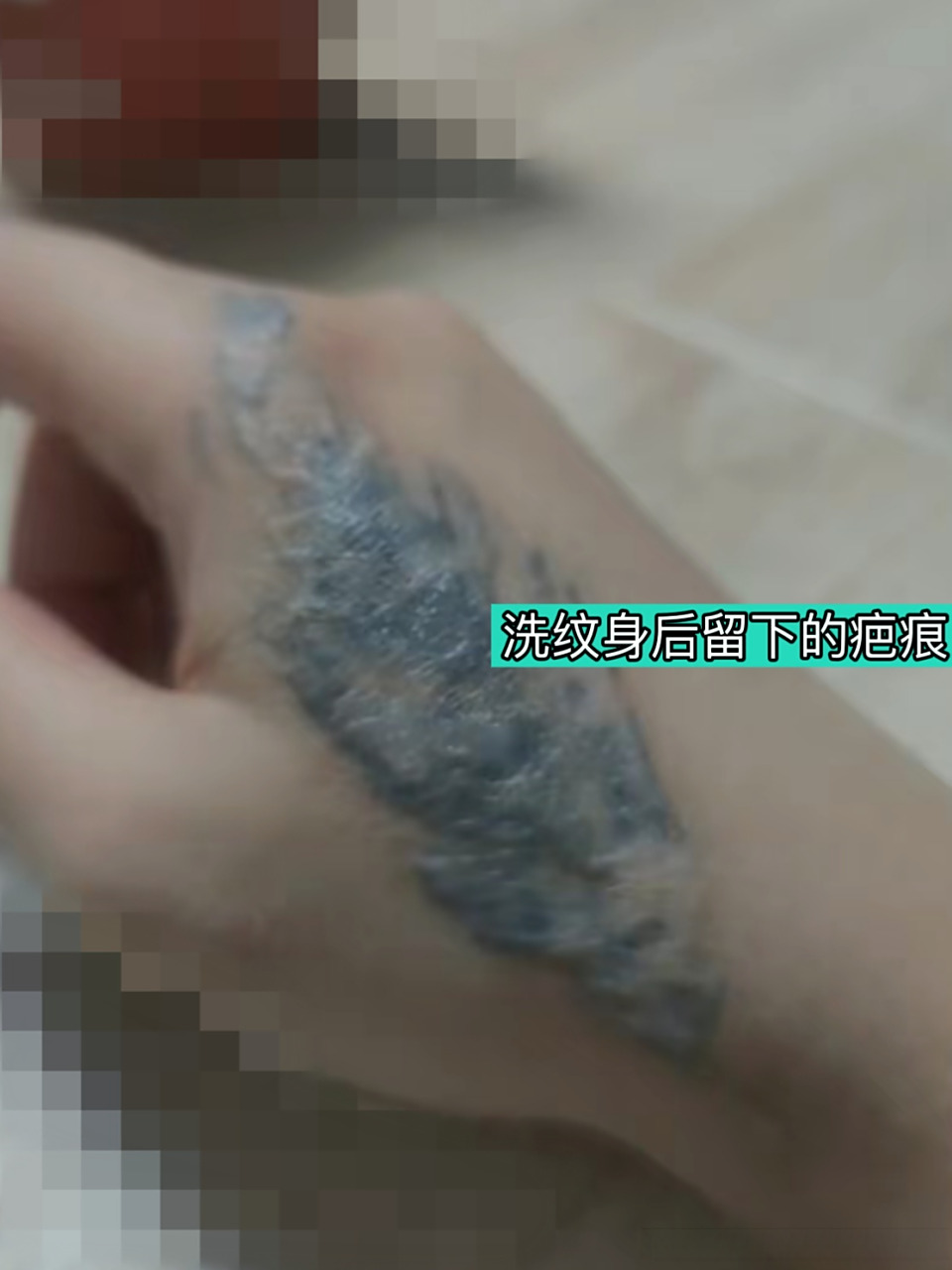 【疤友咨询】洗纹身后留下了增生疤痕,特别难看怎么办?