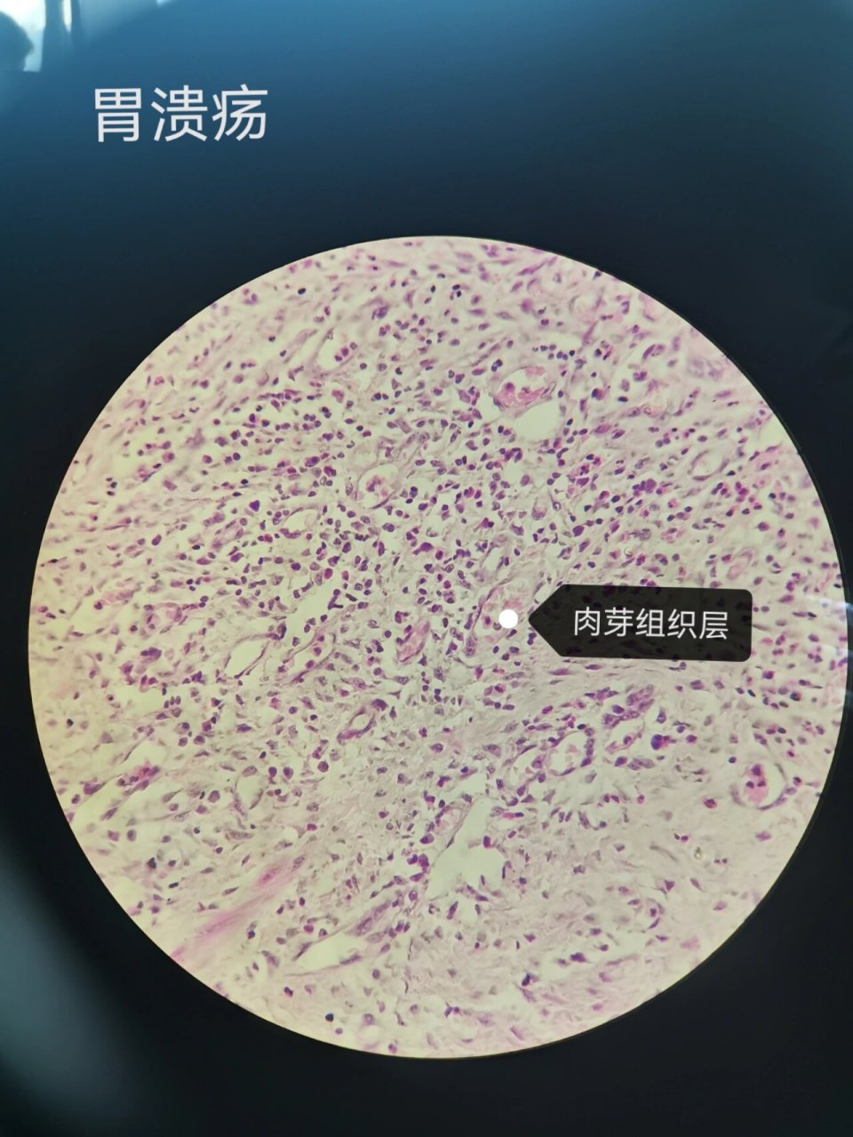 病理学|期末切片复习⑥ 95胃溃疡 镜下描述 ①低倍镜 可见胃粘膜上