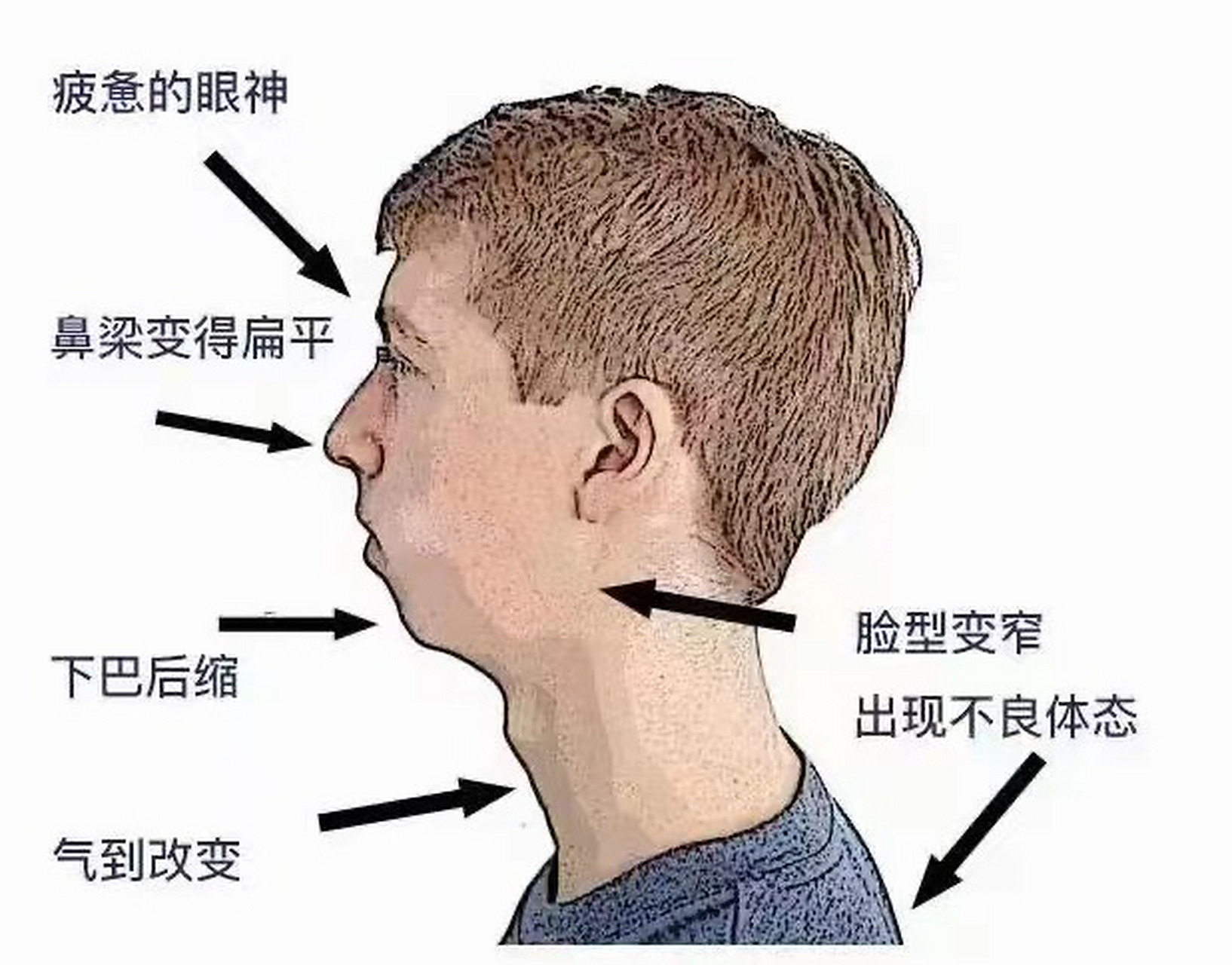 口呼吸的危害,腺样体面容,缺氧,多动,注意力不集中,睡眠质量差