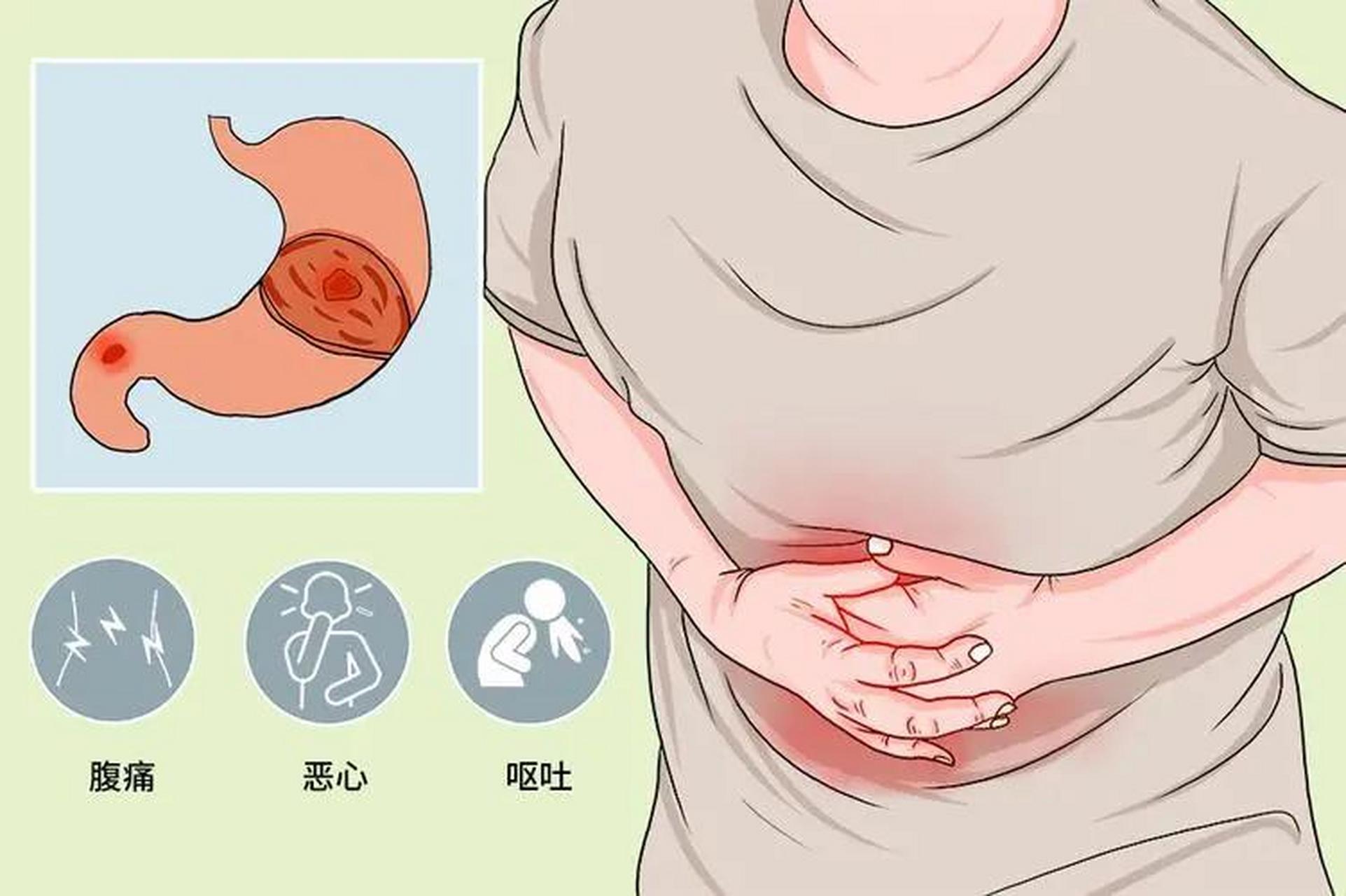 消化性溃疡的常用药物治疗 1,抑酸治疗—质子泵抑制剂 特点: (1)作用