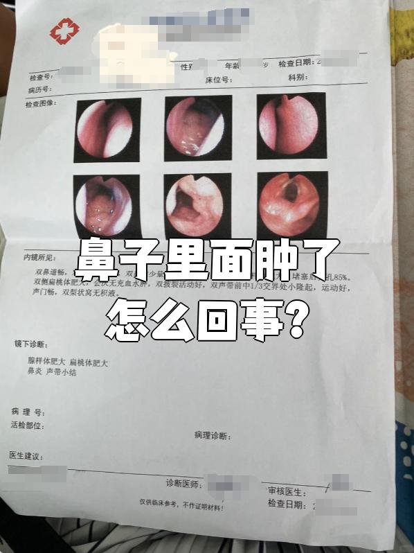 如果是急性鼻炎或慢性鼻炎,鼻黏膜会充血,水肿,下鼻甲也可能肥大