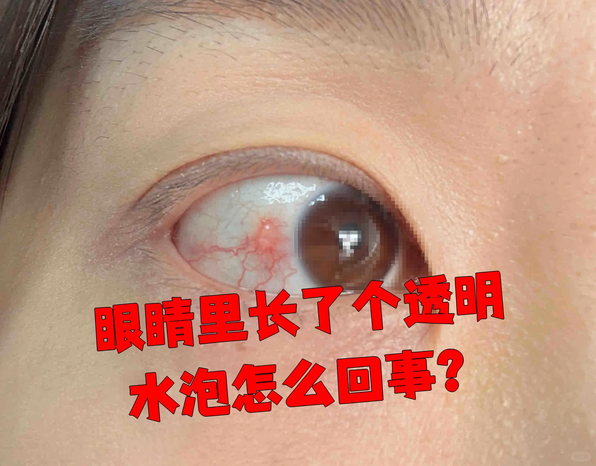 眼睛里长透明水泡可能有这些原因: