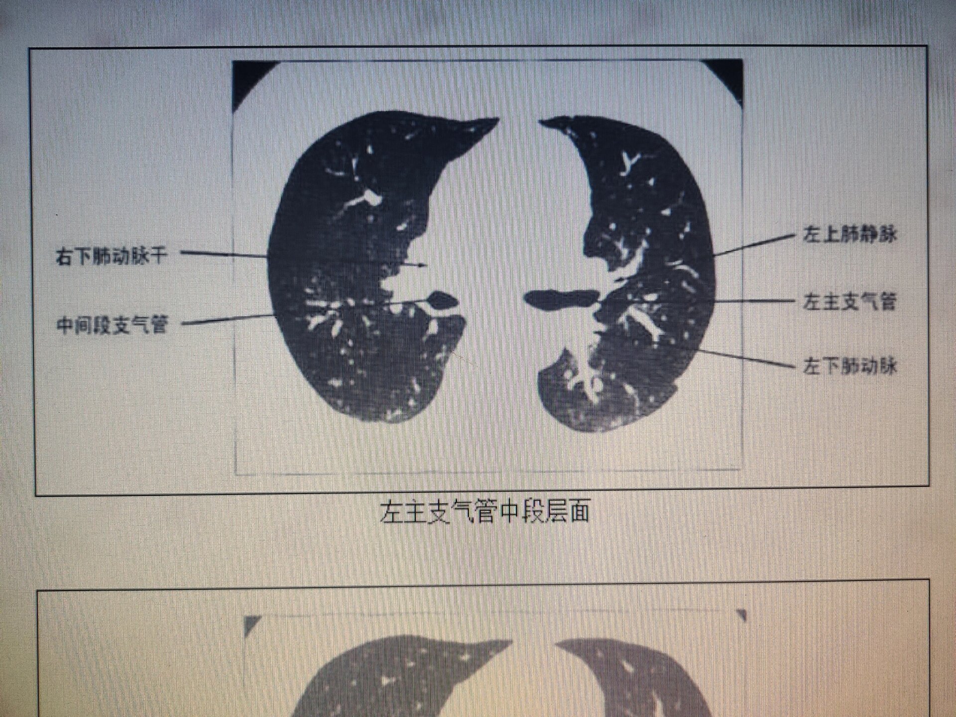 健康肺部ct图片图片