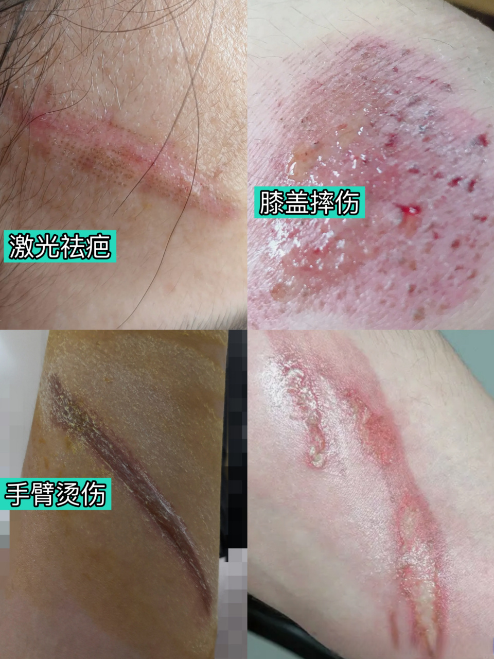 【做好防晒远离色素沉着疤痕】 无论是激光祛疤后的新生皮肤,或是激光