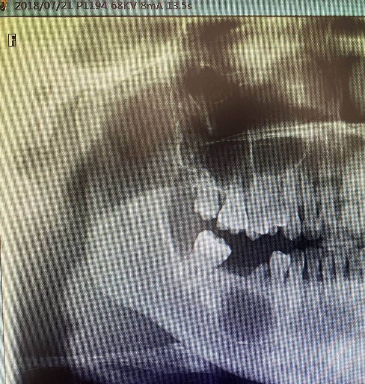 牙囊肿 "牙齿残根不痛不痒,不拔也没事.