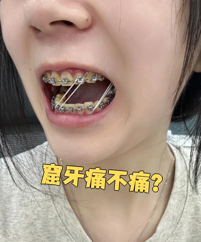 戴牙套的时候,有时候会觉得牙齿酸胀不舒服,但一般不会特别疼