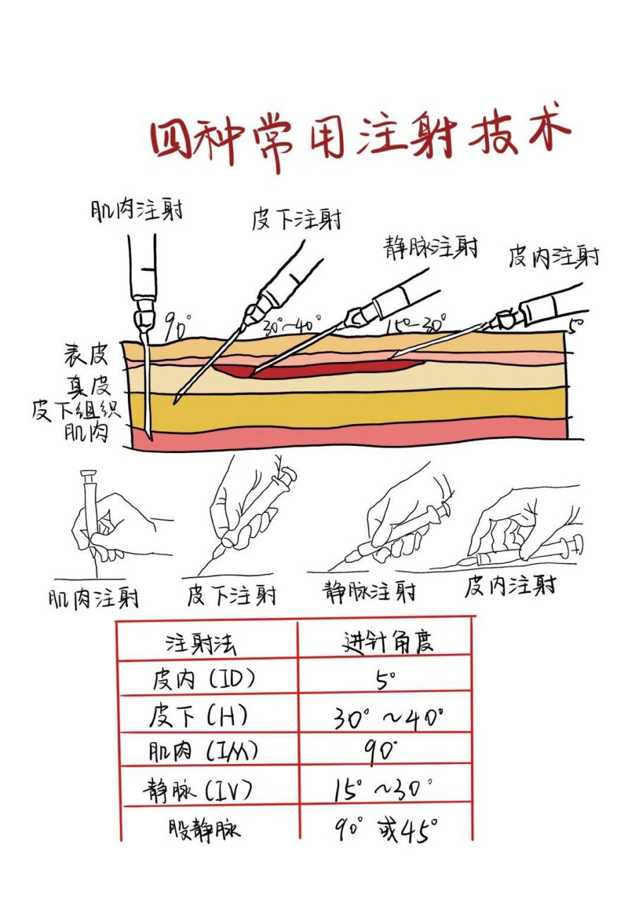 四种常用注射技术
