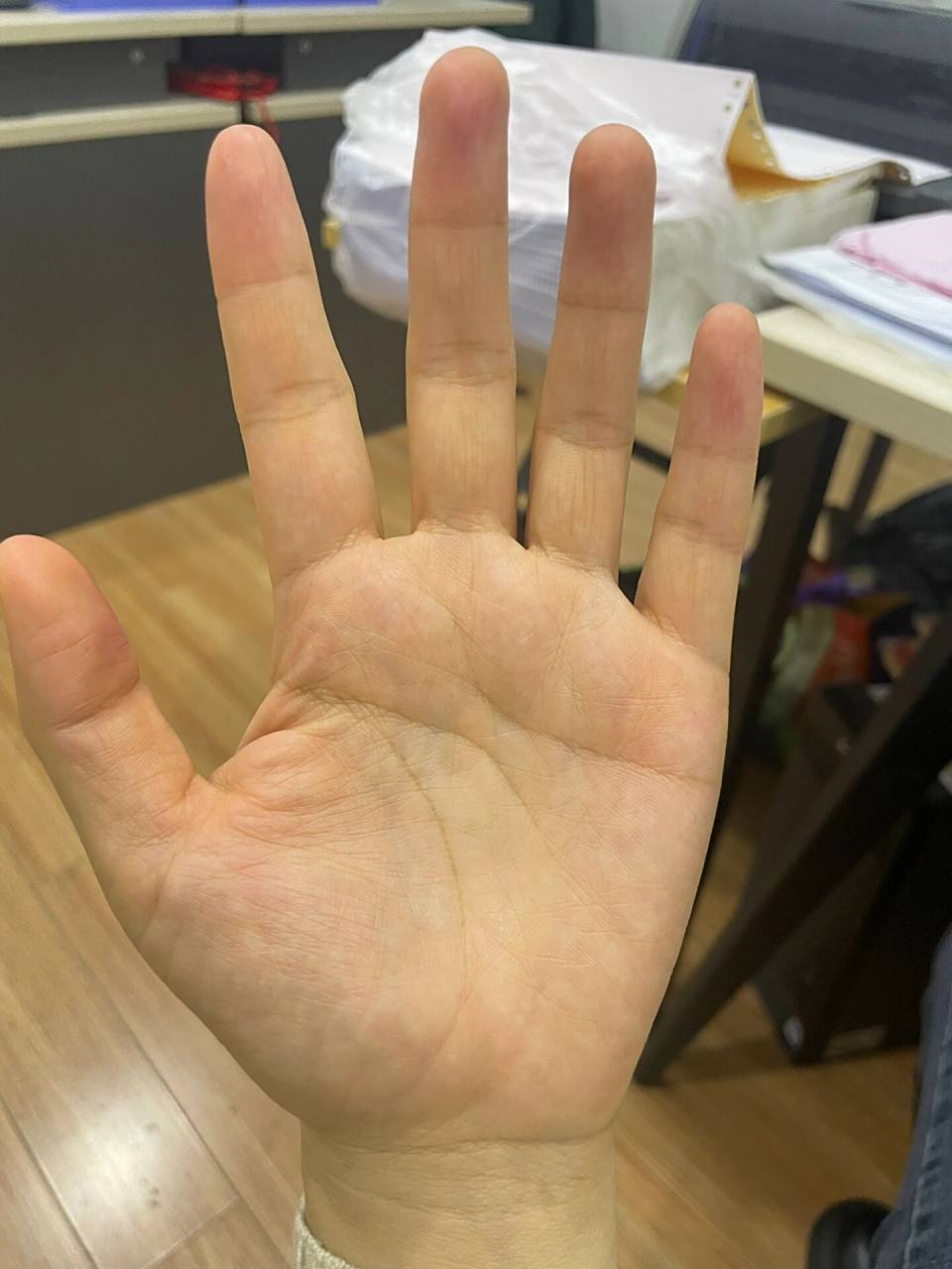 手心发黄是怎么回事?