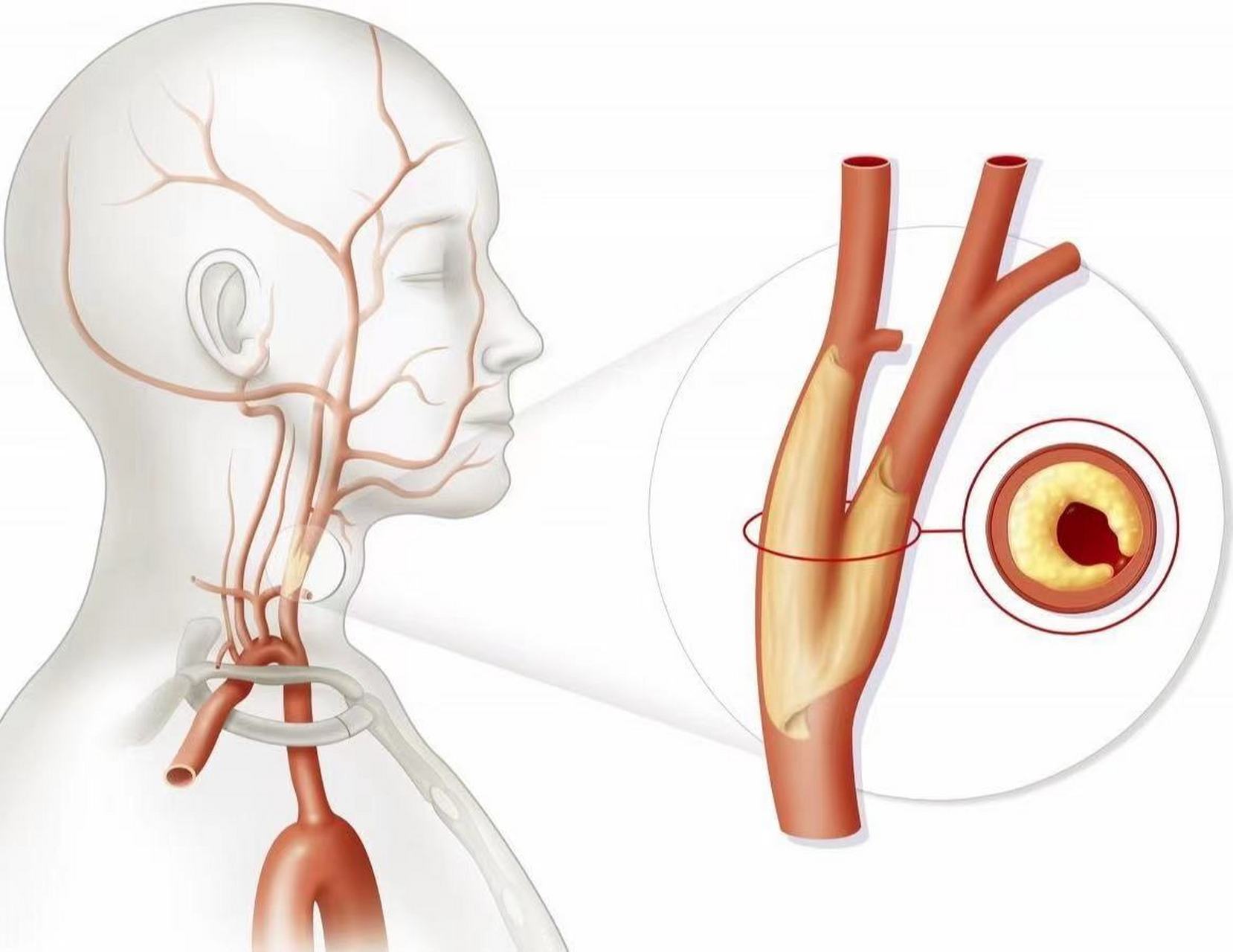 疾病治疗 颈动脉斑块目前主要依靠药物治疗,手术治疗及其他治疗.