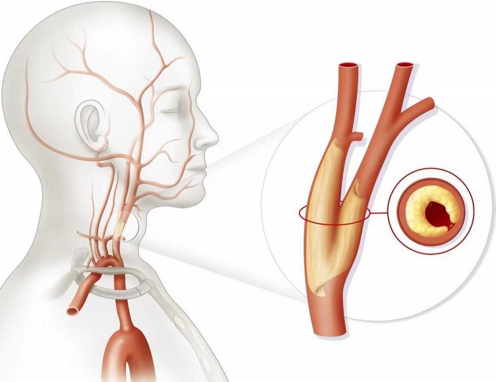 颈动脉斑块图片及说明图片
