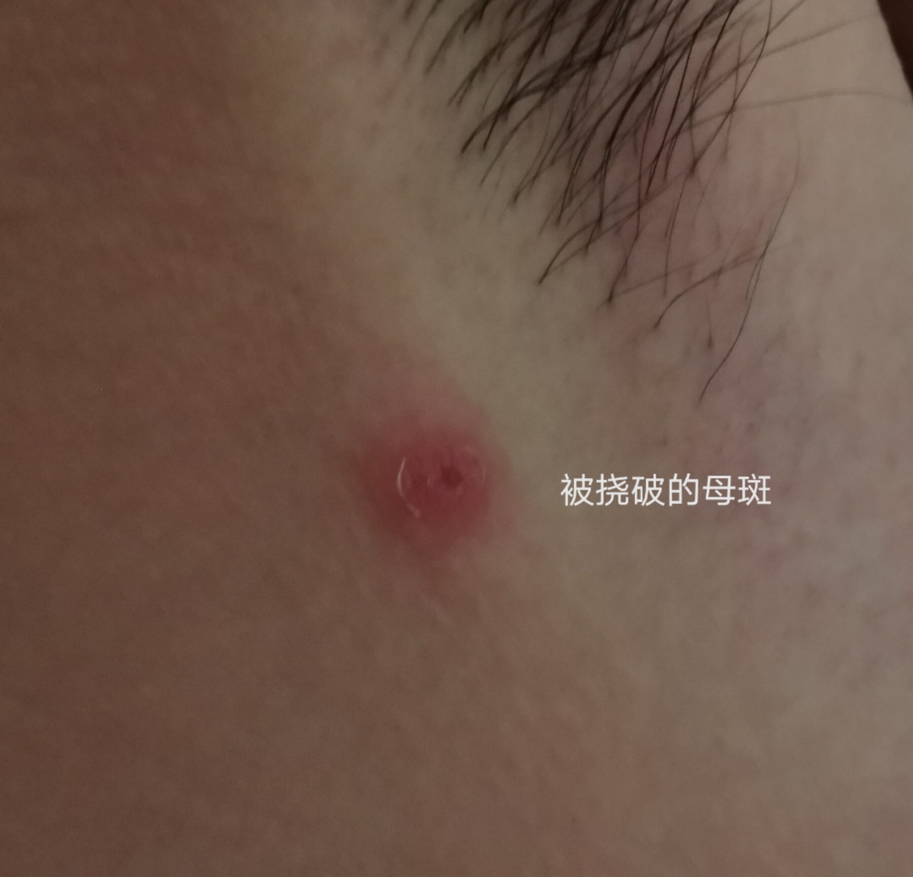 21,突然感到腋窝有点疼,然后发现了一颗红痘,以为是是个粉刺,就没在意