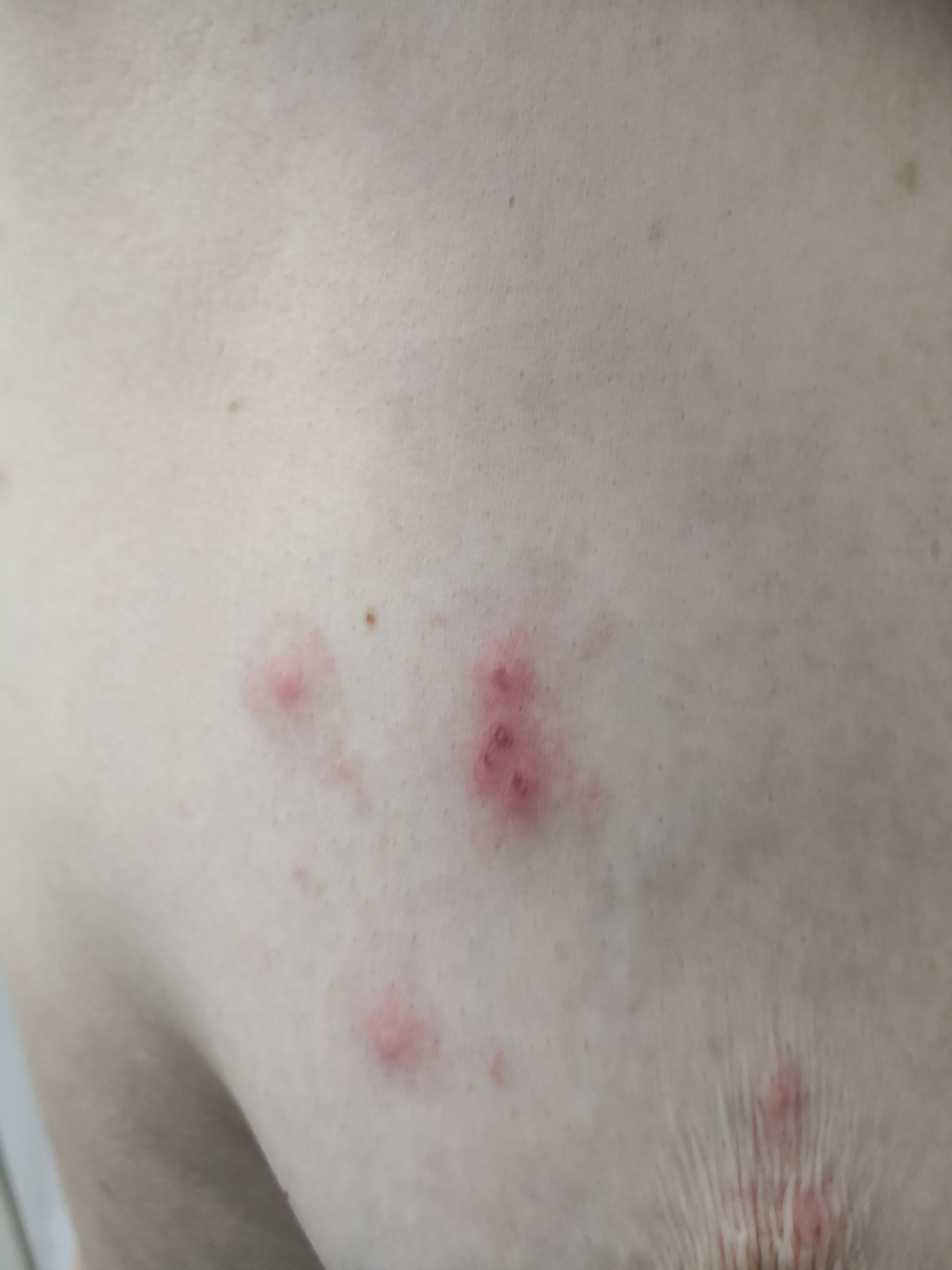 右侧前胸后背的带状疱疹早期症状!#带状疱疹