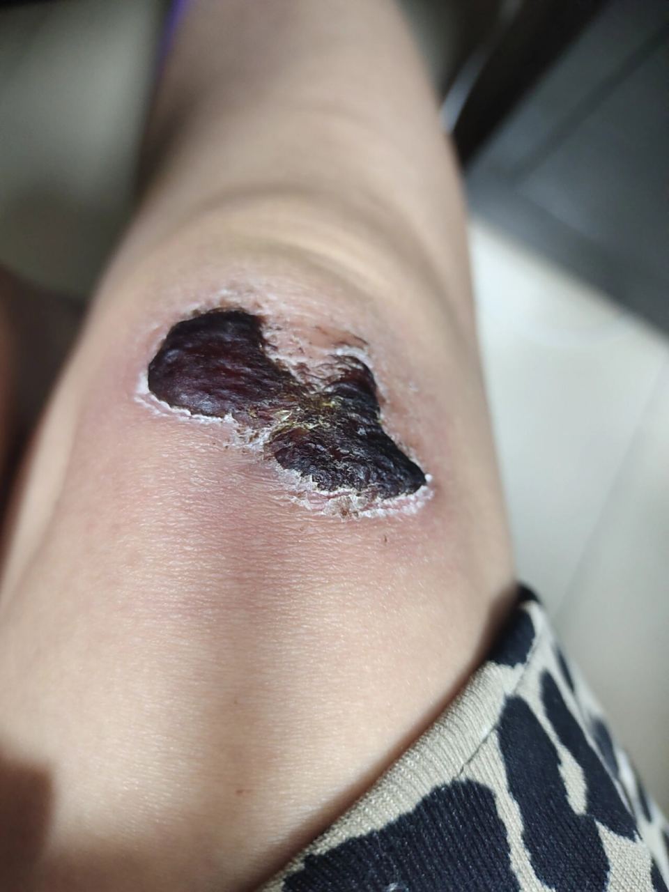 膝盖摔伤结痂多久才会掉 膝盖摔伤第十天,要不要涂什么祛疤产品 完美