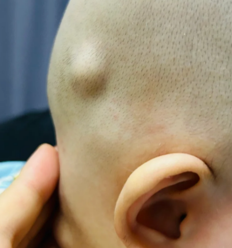 婴儿头上出现软包,常见原因包括产瘤,脂肪瘤或淋巴结肿大,具体处理