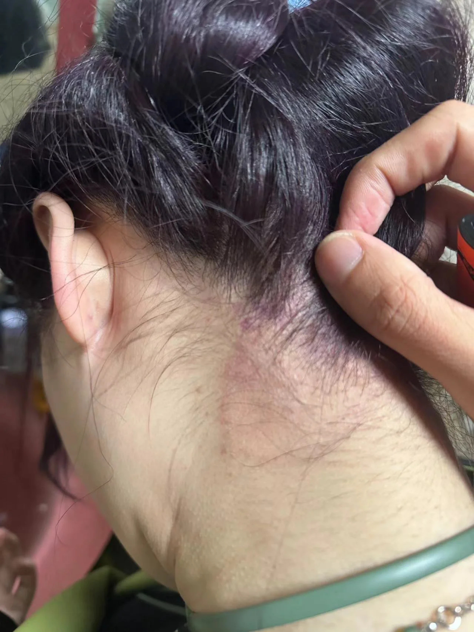 染发后脖子起疹子,商家不搭理,我该怎么办01 11.