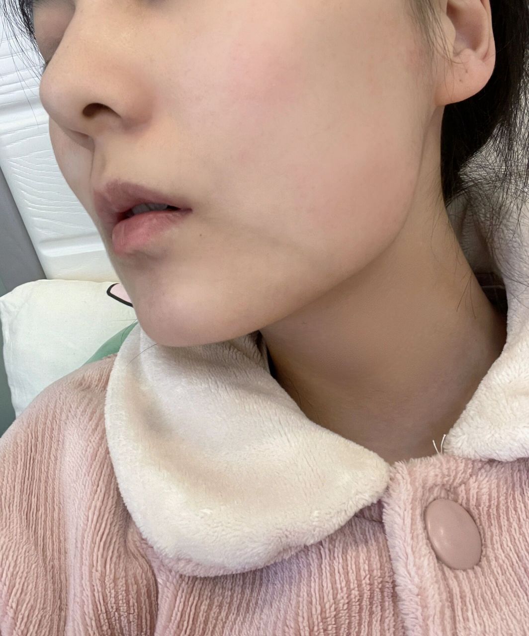 嘴角为啥有条青筋 很不理解我脸上嘴角多一条青筋,很明显,化妆盖不住