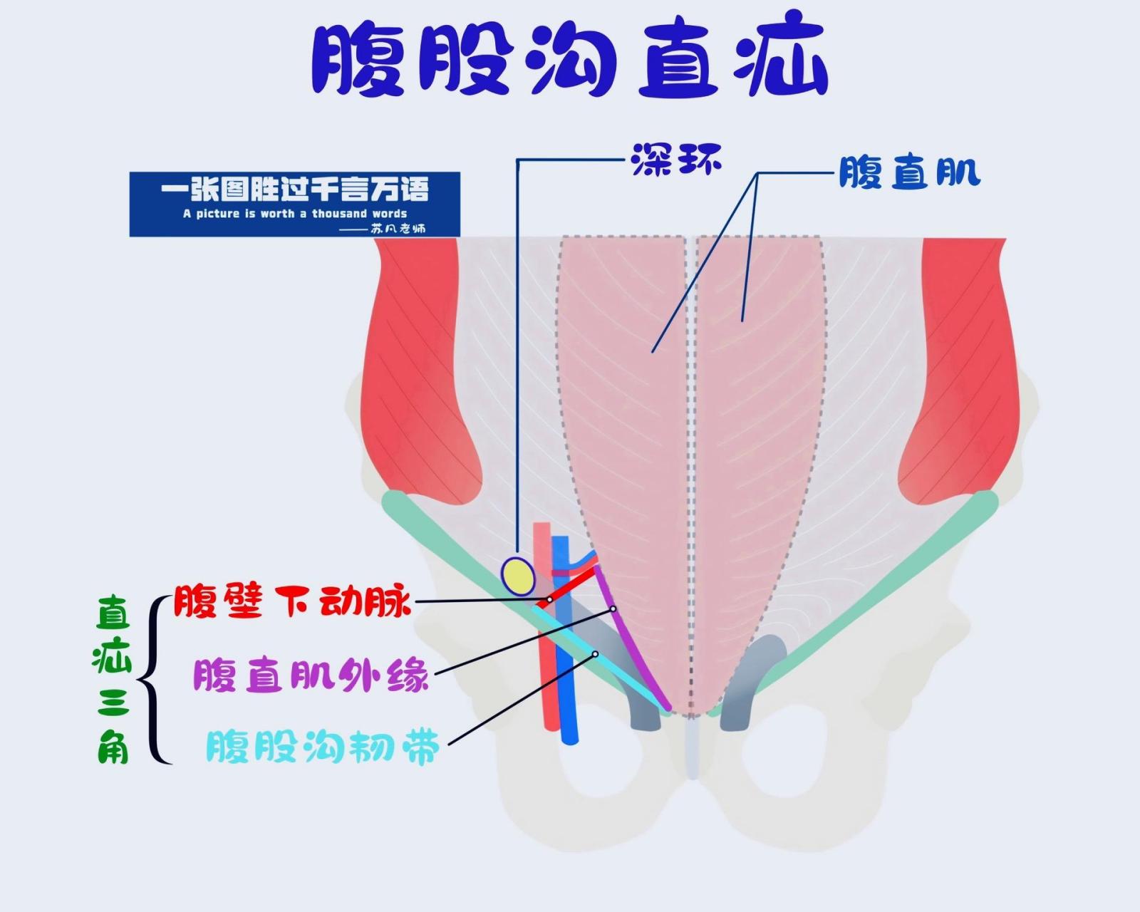 腹股沟疝(直疝&斜疝)直疝和斜疝简化版示意图来了哦!