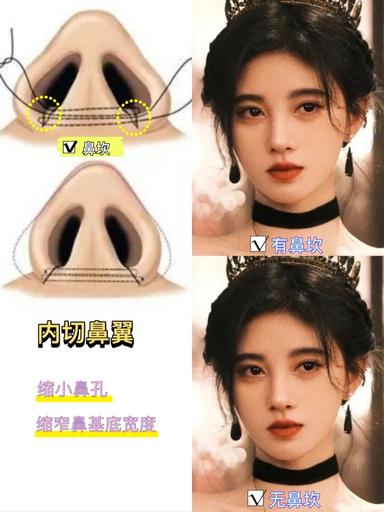 鼻翼内切和外切对鼻子影响有多大? 鼻翼外切才是拯救大鼻头的要点!