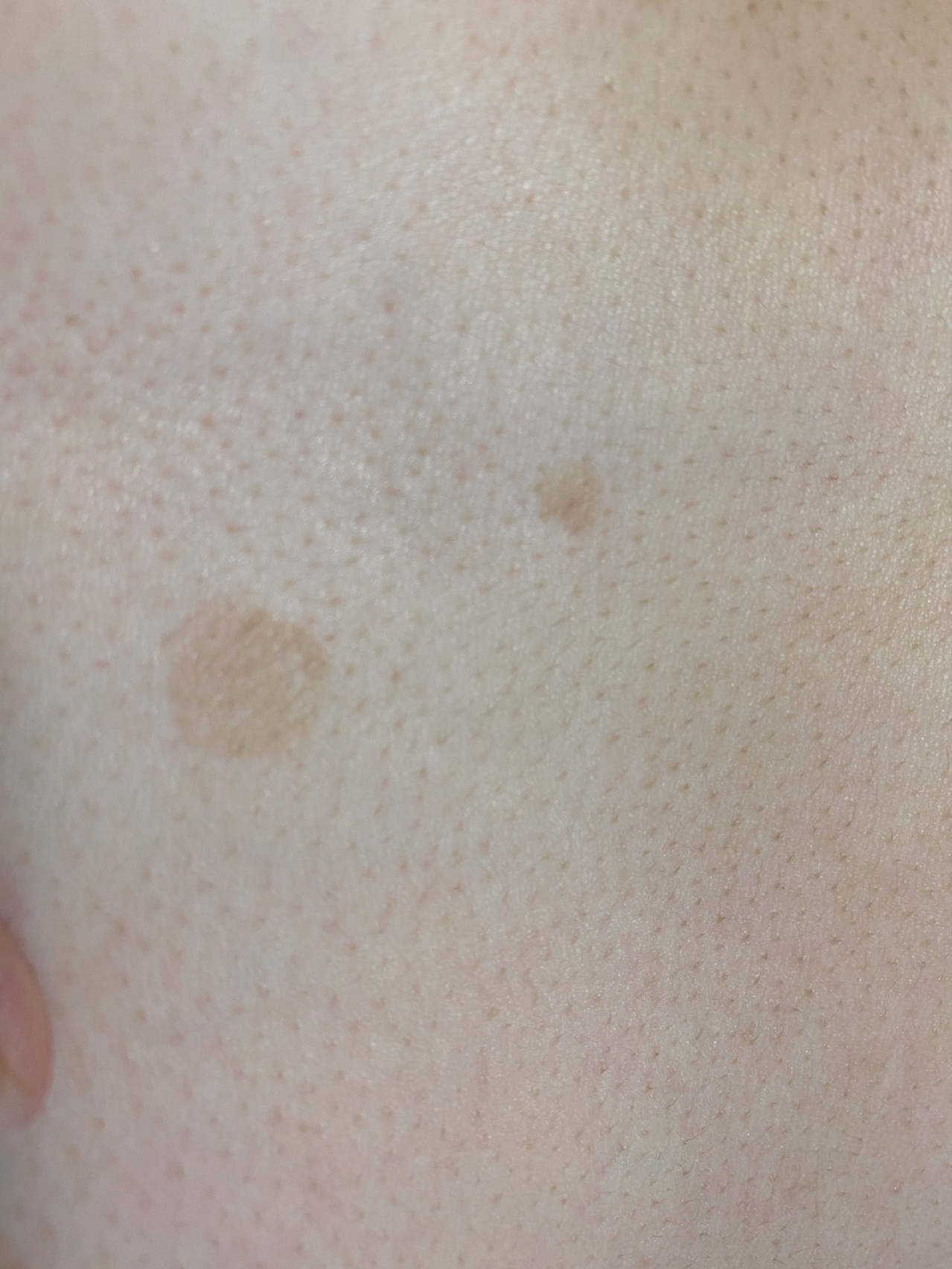 身上忽然长起了花色的斑点