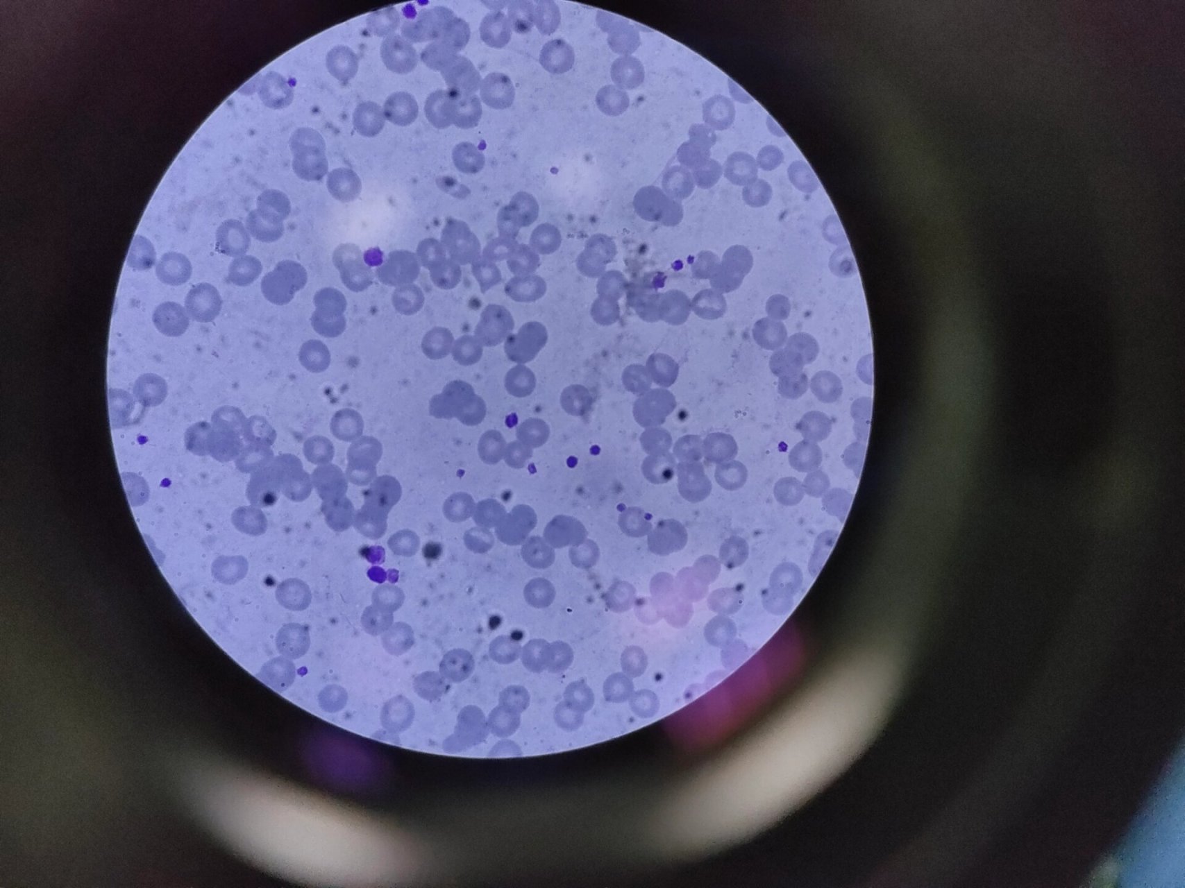 图二:红细胞形态异常,可见红细胞碎片