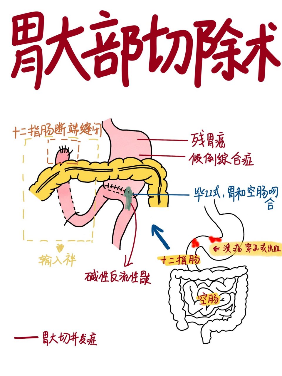 胃切除手术方式图片图片