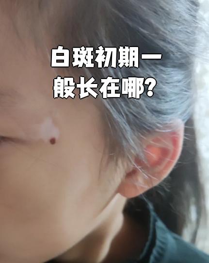 白斑刚开始出现时,最常见于头部,颈部,脸部和四肢这些容易被太阳晒