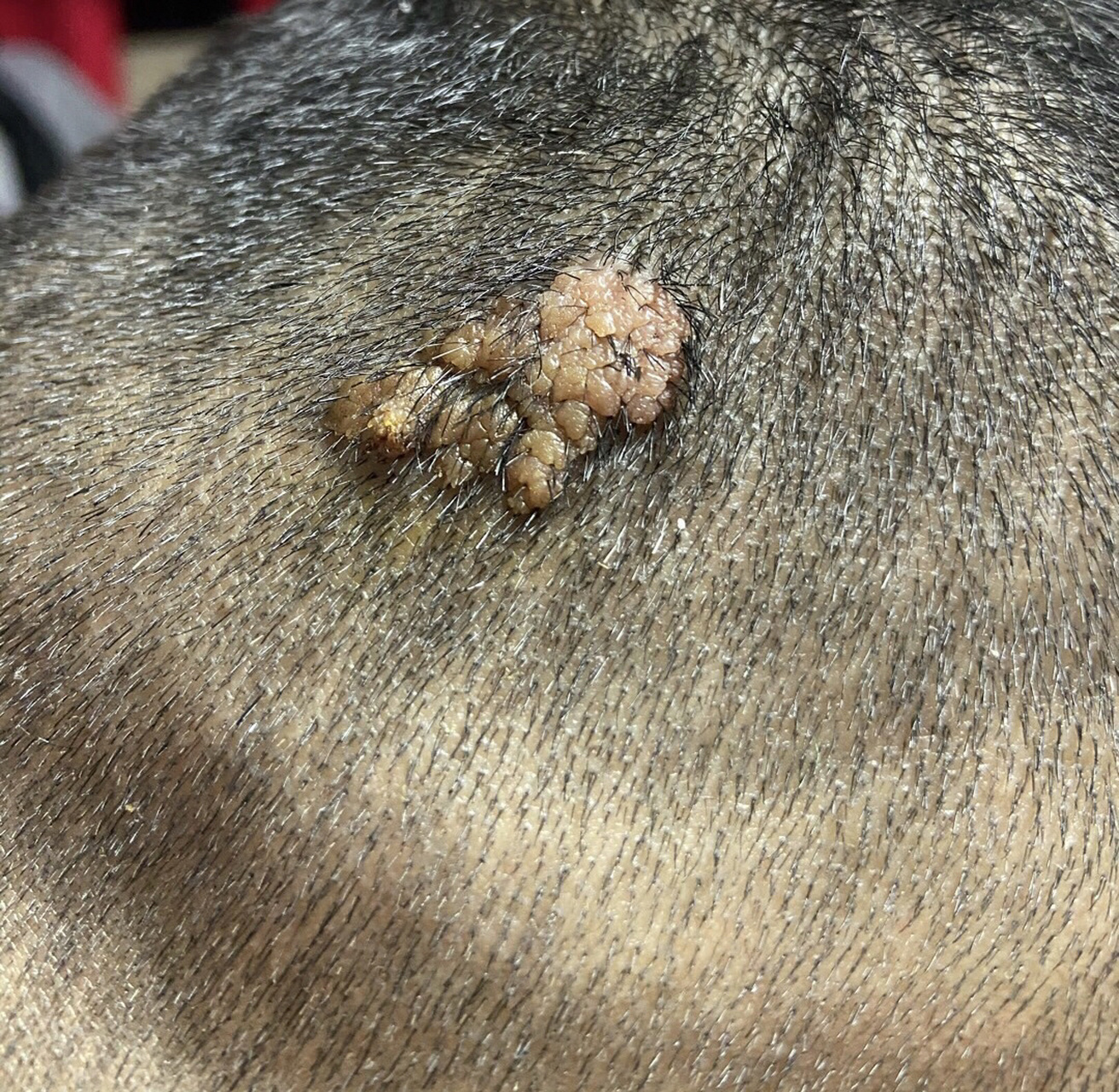 菜花状头皮疣切忌手欠!