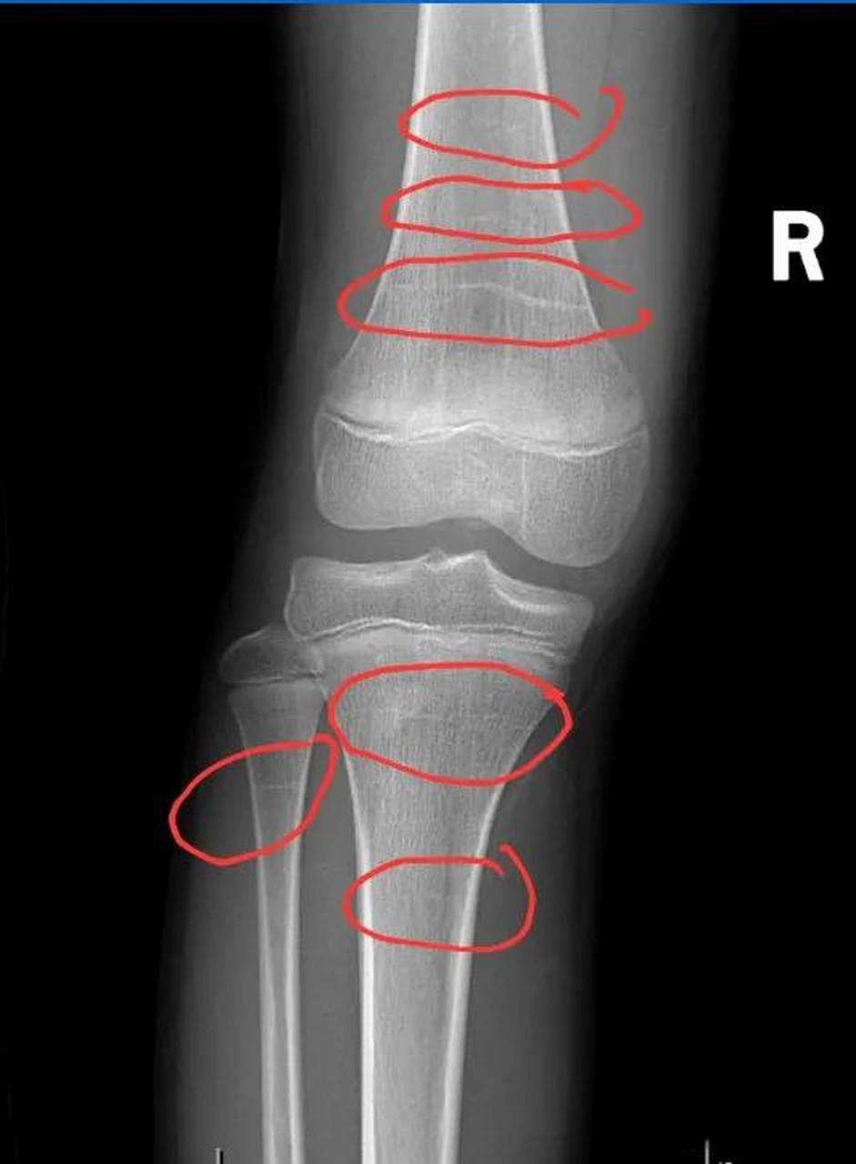 膝关节骨骺线图片图片