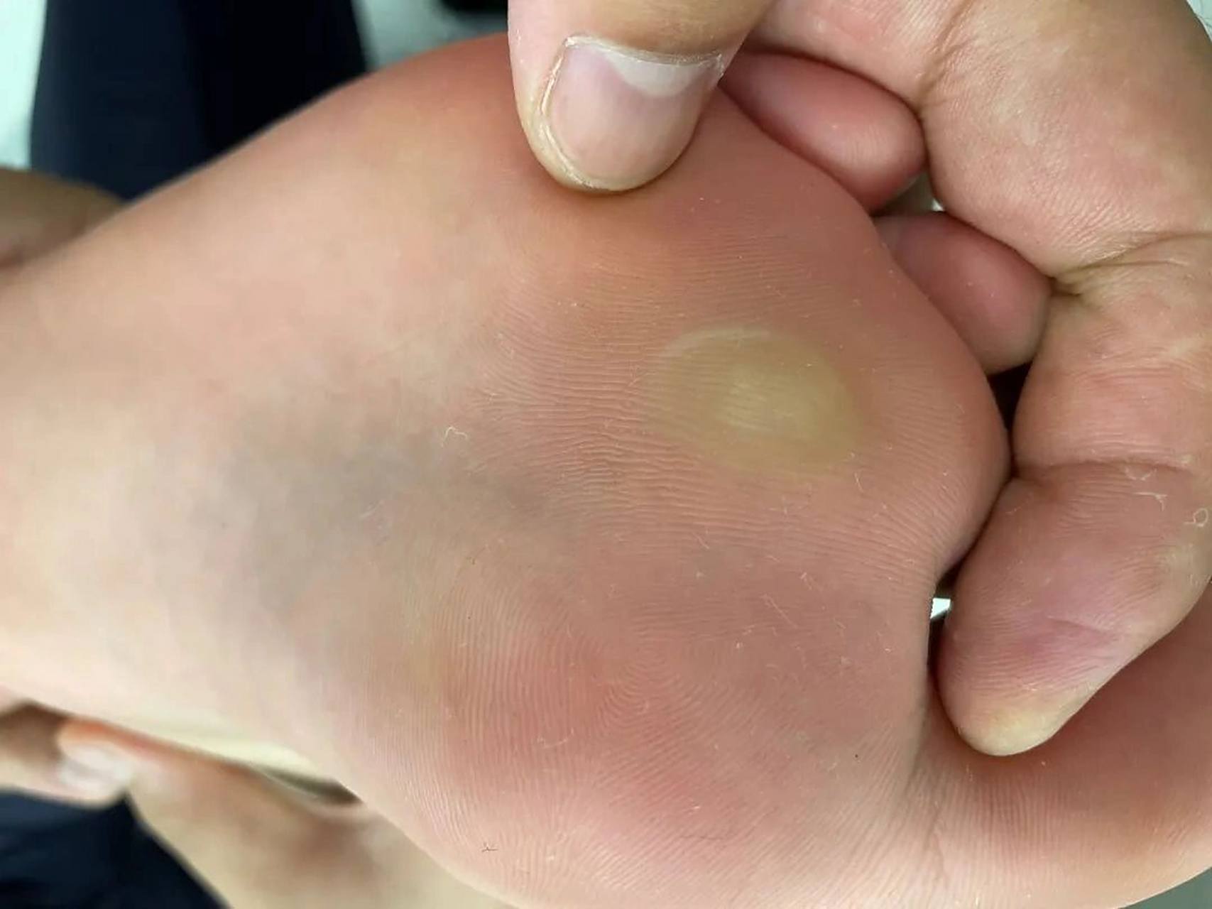 脚上长硬疙瘩,疼痛难忍,你还以为是鸡眼?