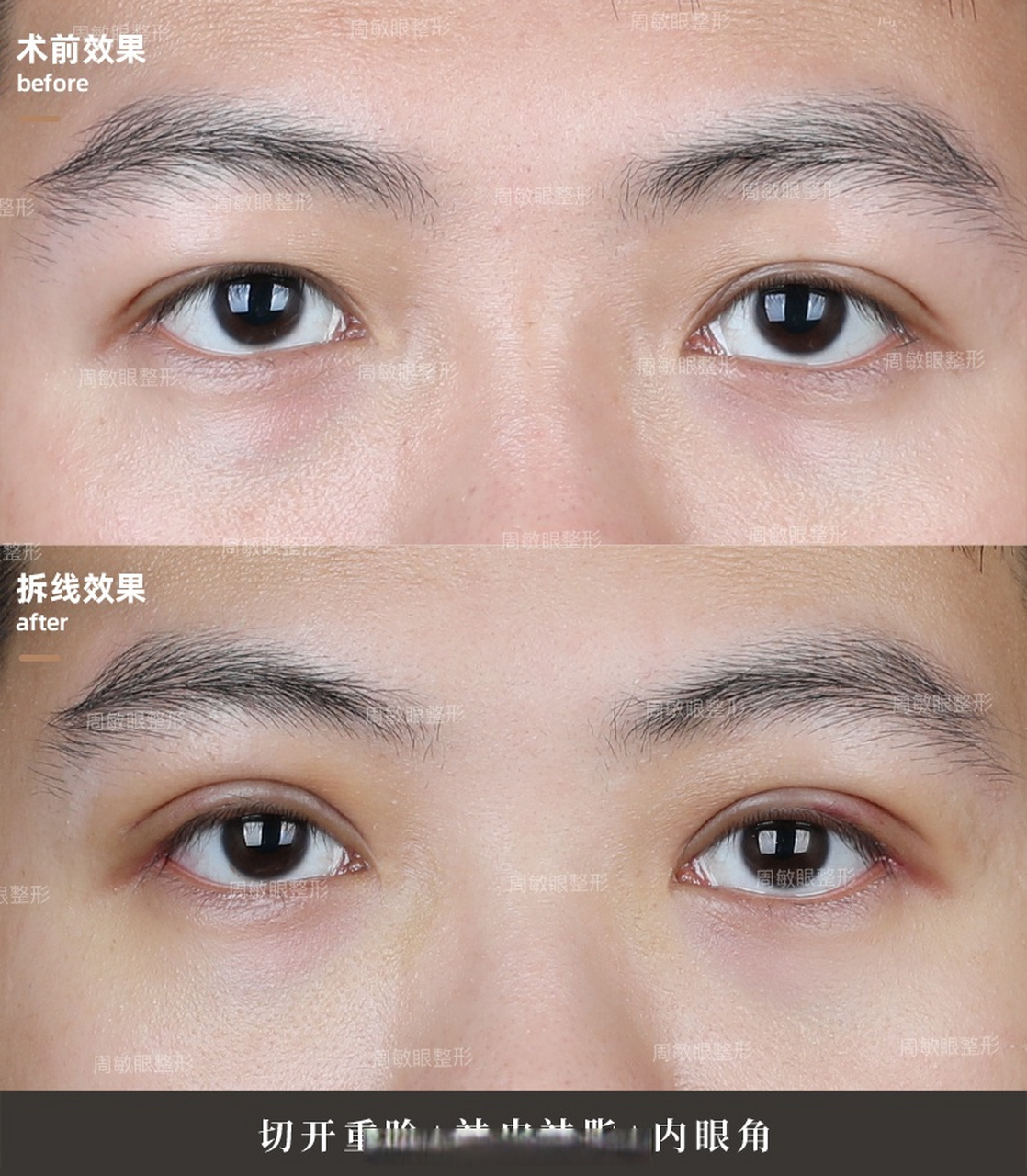 男士全切双眼皮案例分享,术后1个半月全方位效果展示[并不简单]#周敏