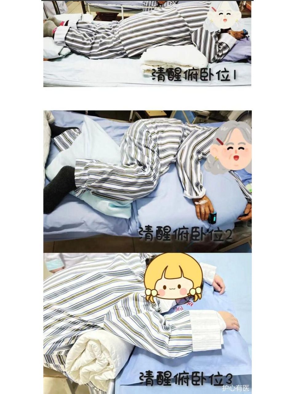 新冠肺炎阳性后"俯卧位通气"助力恢复 俯卧位通气,通俗讲就是让患者趴