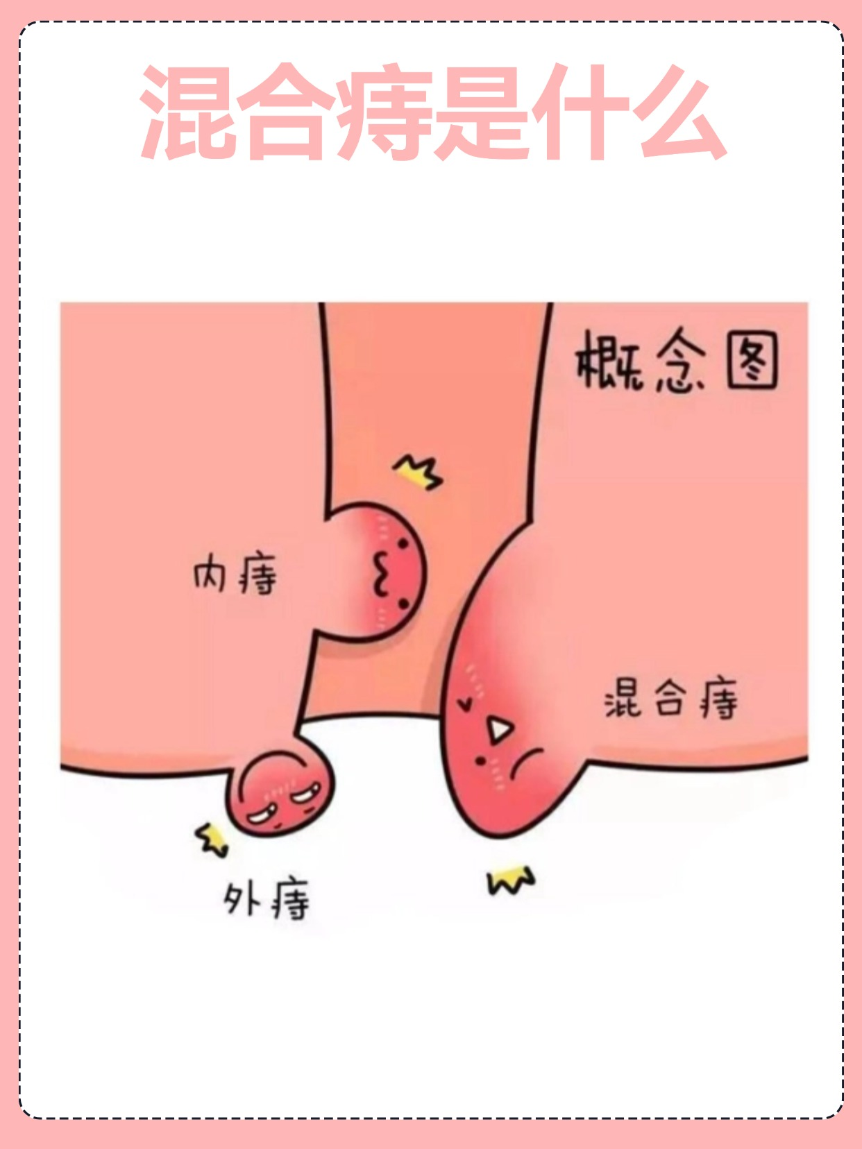 痔疮混合痔手术切口数量不固定,一般1