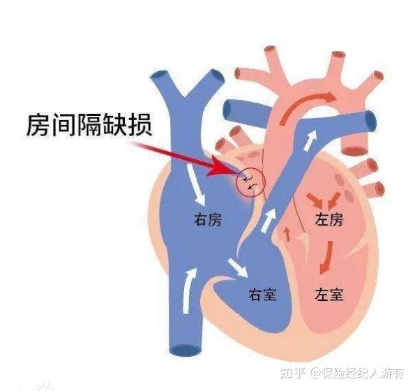 新生儿房间隔缺损图片