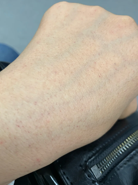 手上的小红点像血点是什么