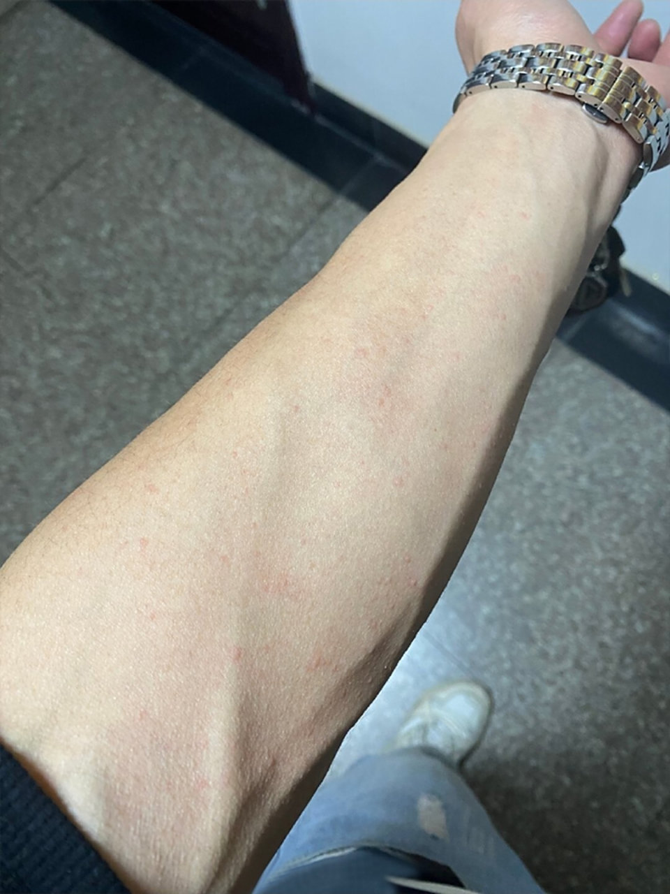 我本身患有胆碱性荨麻疹,要想治好,必须做到一下几点每天坚持跑步,第