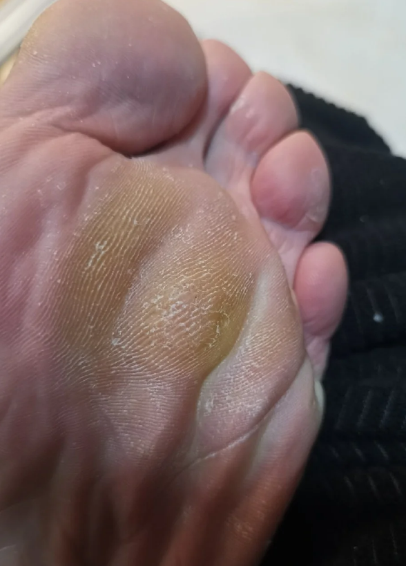 脚底板长硬茧子,最常见的原因有三种:胼胝,鸡眼和跖疣